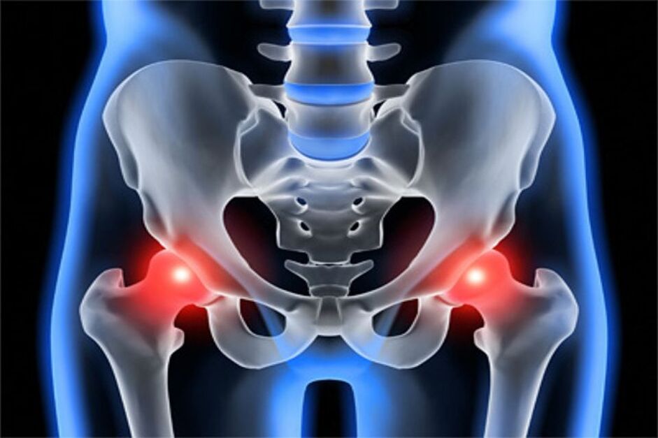 Деформирующий остеоартроз тазобедренных суставов (коксартроз)